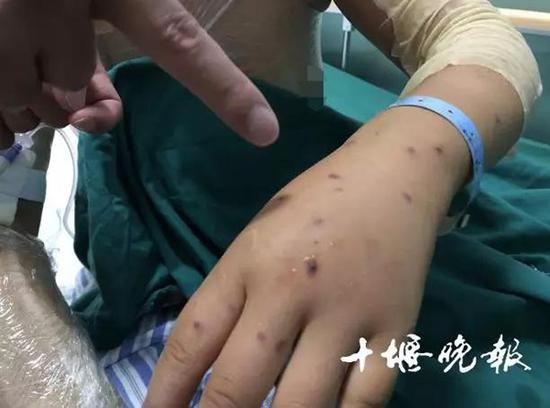 四川山中菌子香，蜂群蜇伤需警惕